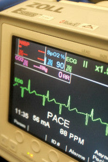 Task 3.4.3 - Cardiac Pacing